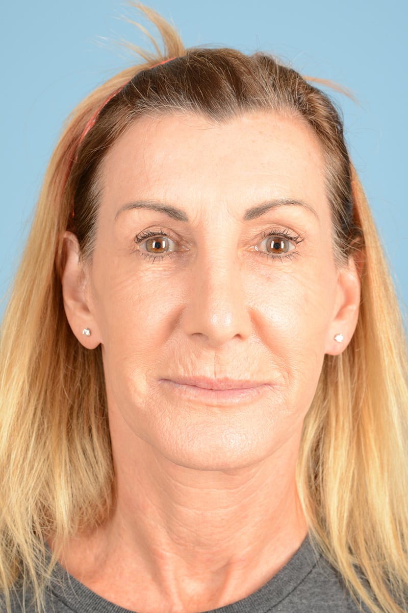 Laser Resurfacing Before & After Image