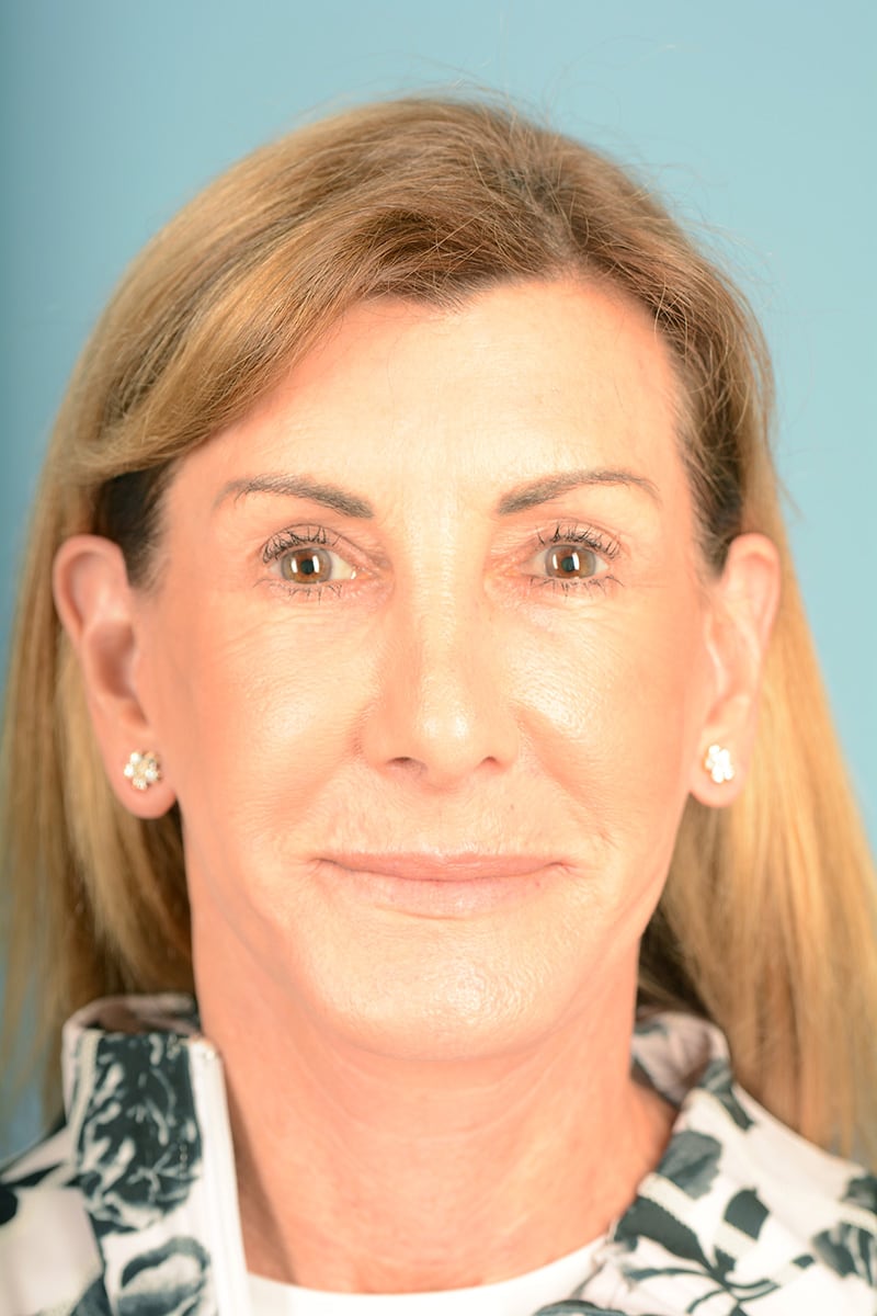 Laser Resurfacing Before & After Image