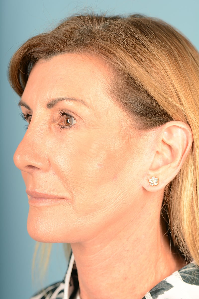 Laser Resurfacing Before & After Image