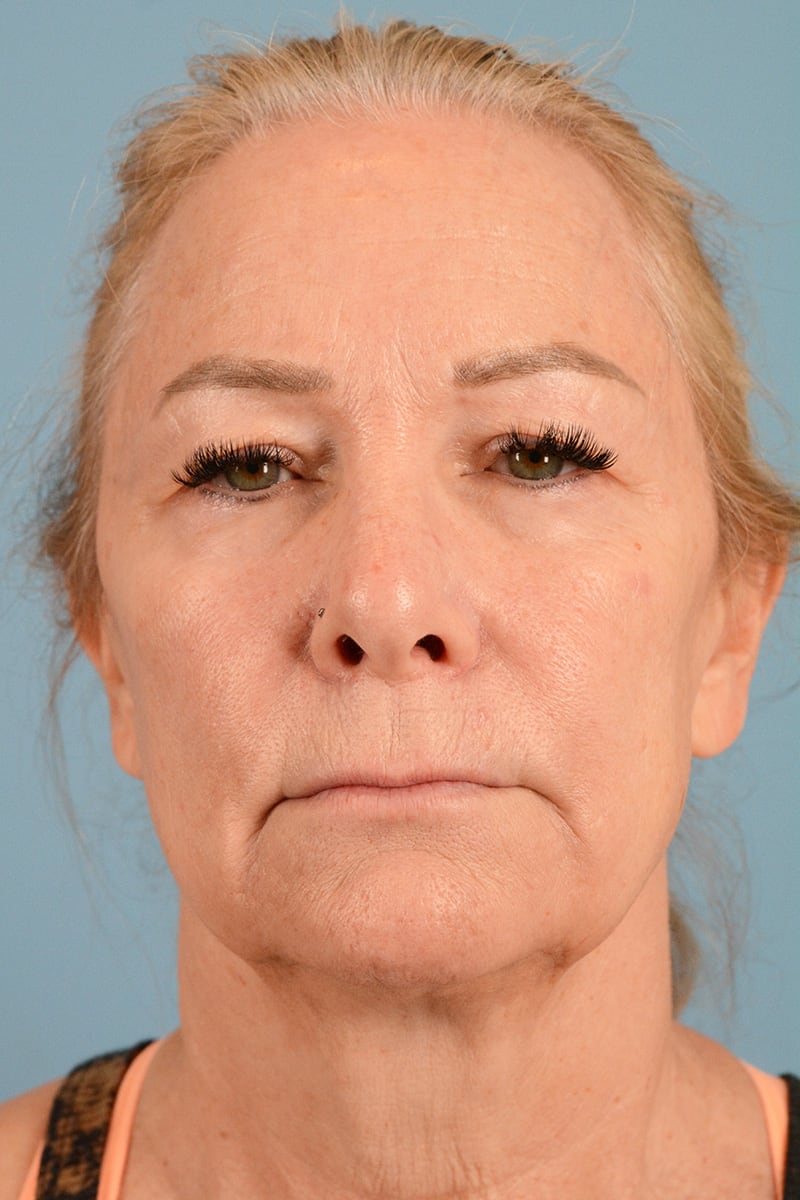 Laser Resurfacing Before & After Image