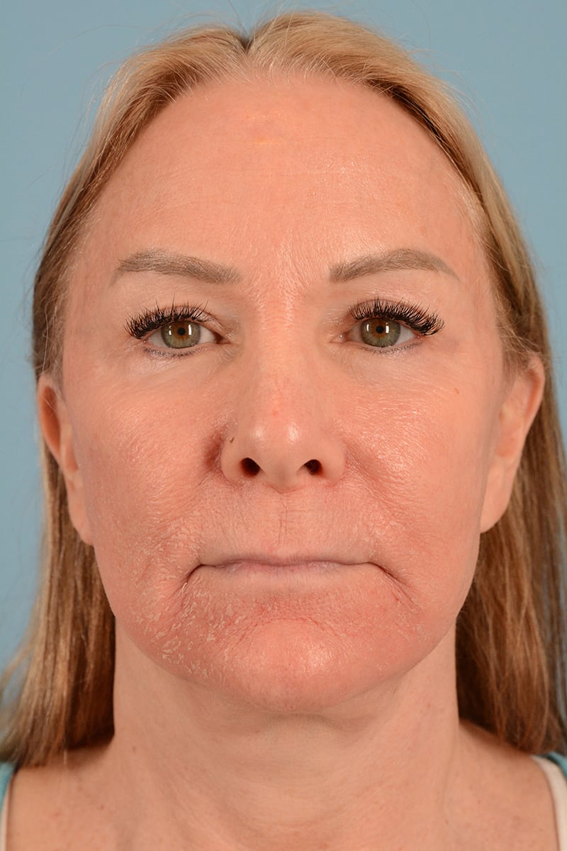Laser Resurfacing Before & After Image