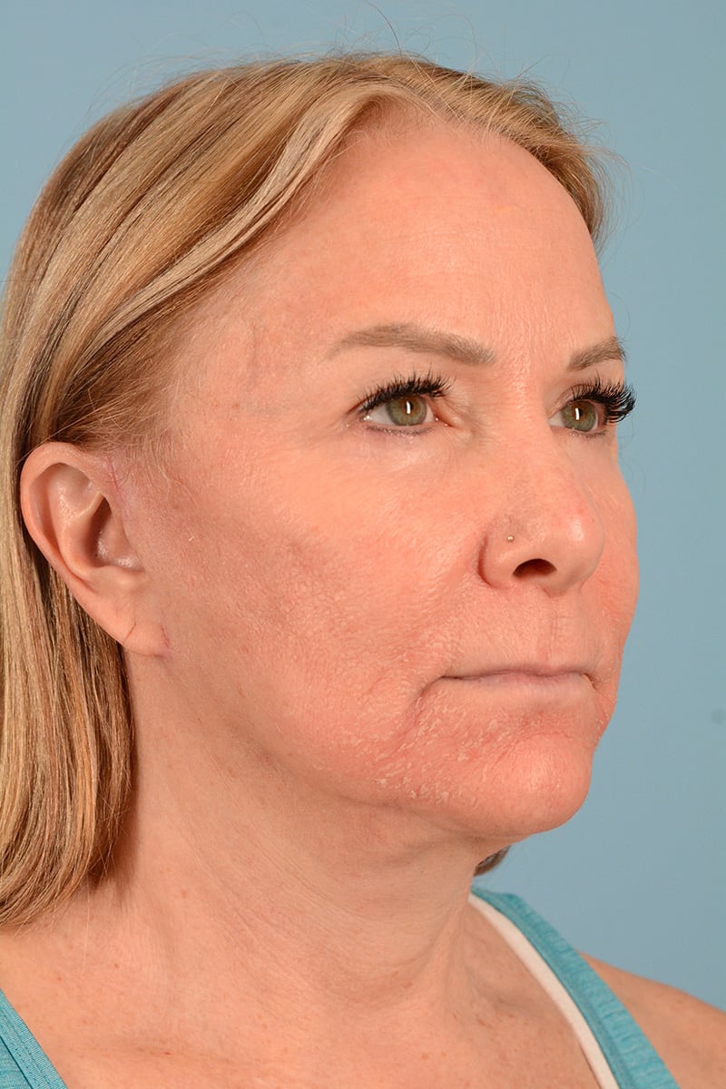 Laser Resurfacing Before & After Image