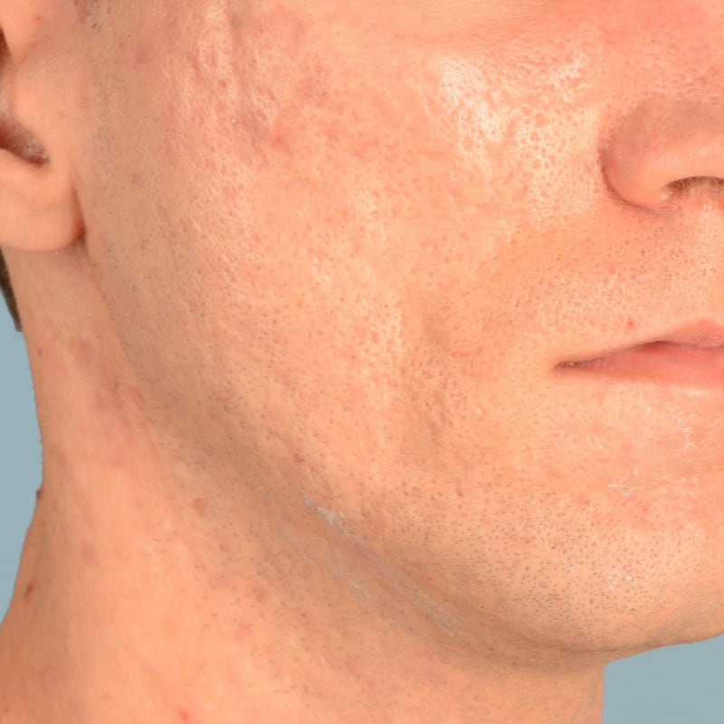 Sebacia (Acne Treatment) Before & After Image