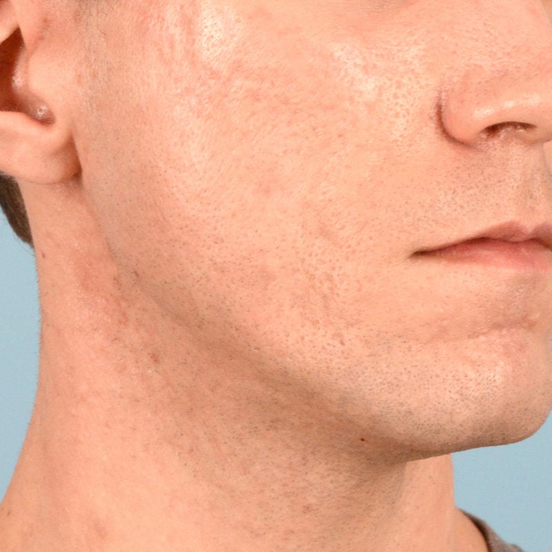 Sebacia (Acne Treatment) Before & After Image