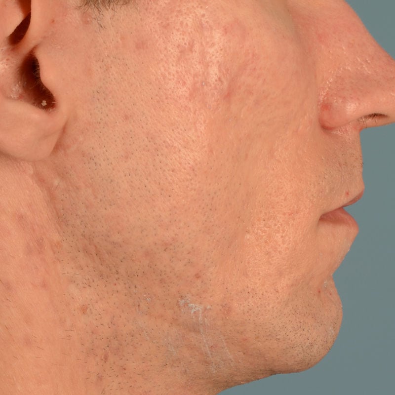 Sebacia (Acne Treatment) Before & After Image