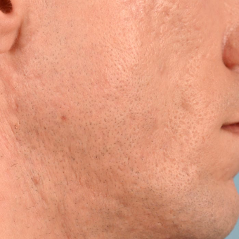 Sebacia (Acne Treatment) Before & After Image