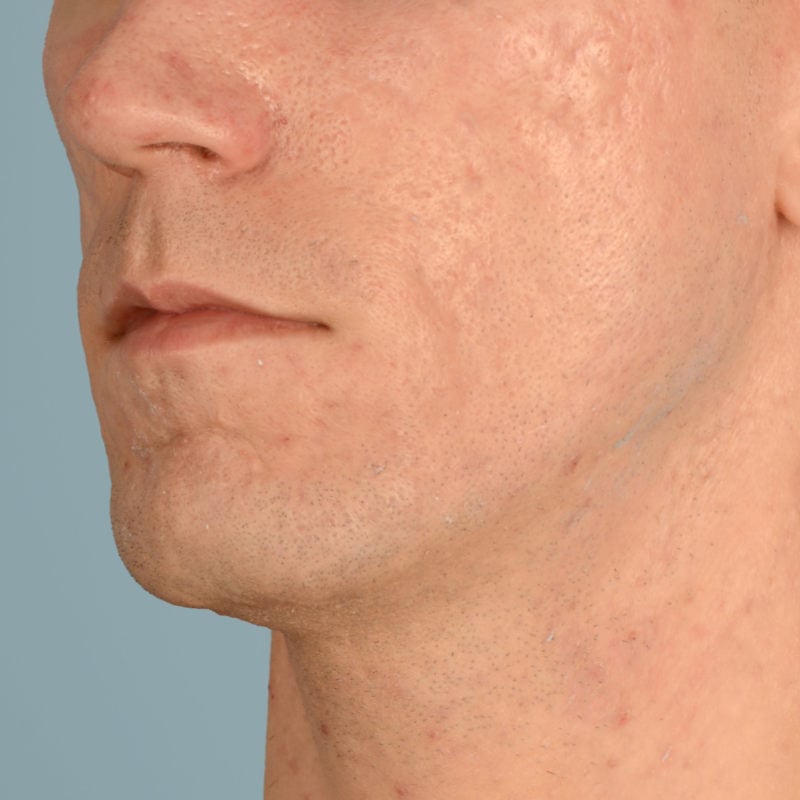 Sebacia (Acne Treatment) Before & After Image