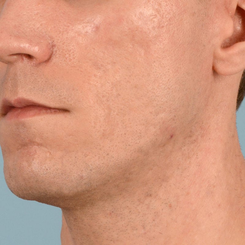 Sebacia (Acne Treatment) Before & After Image