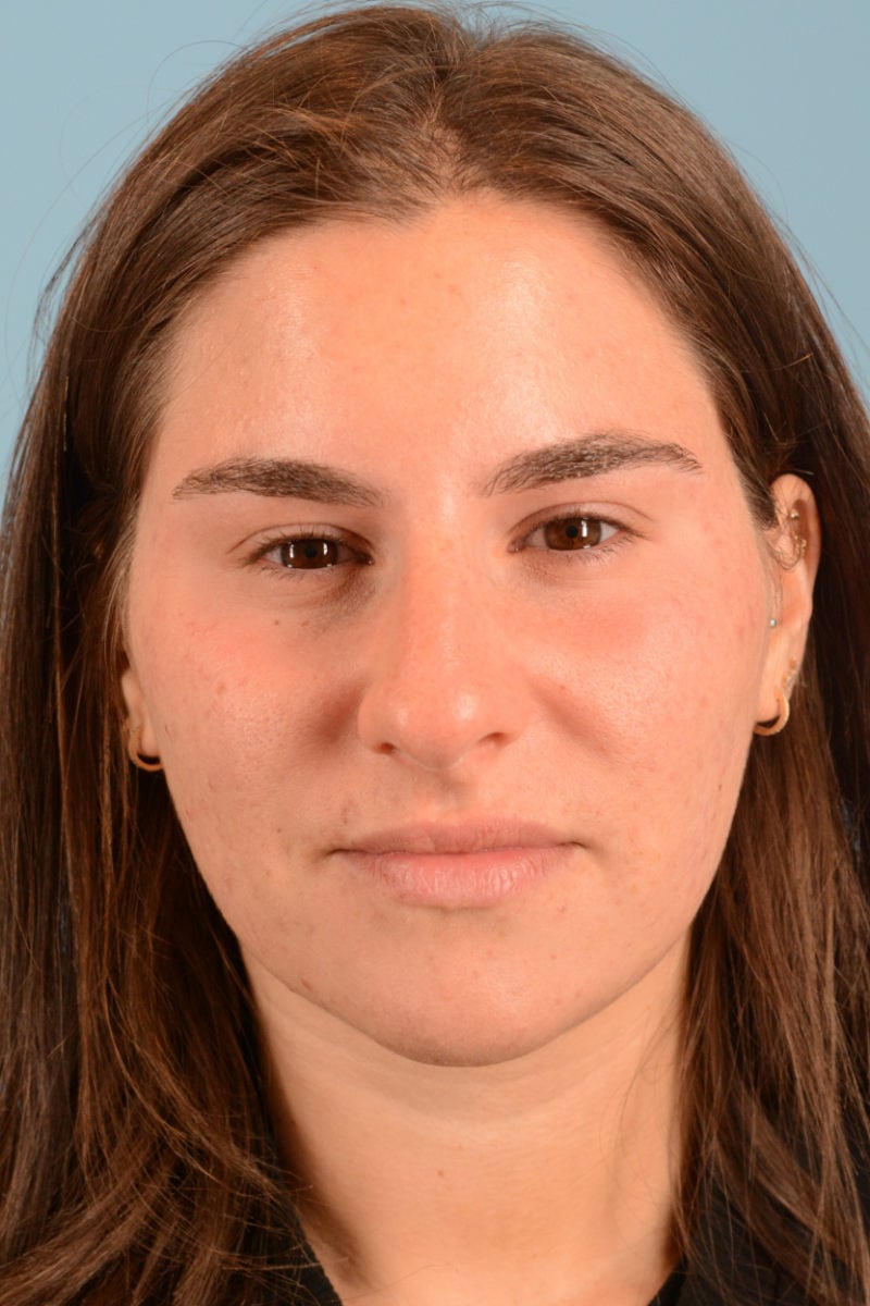 Sebacia (Acne Treatment) Before & After Image