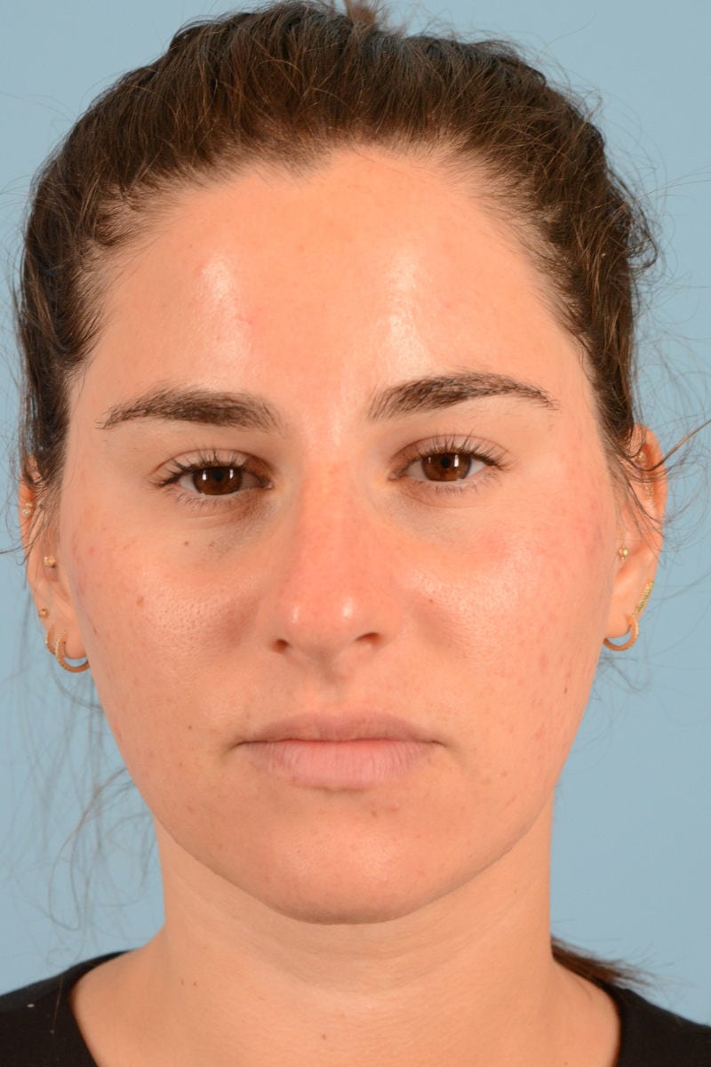 Sebacia (Acne Treatment) Before & After Image