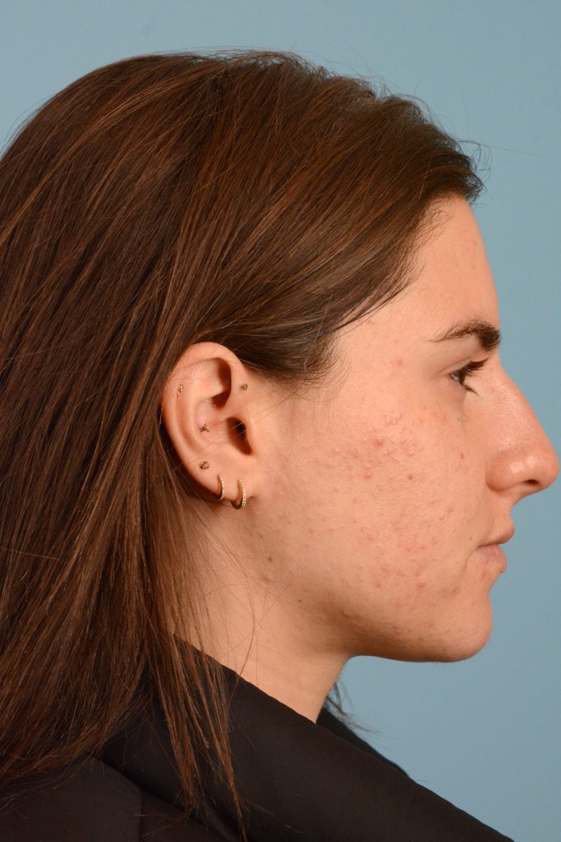 Sebacia (Acne Treatment) Before & After Image