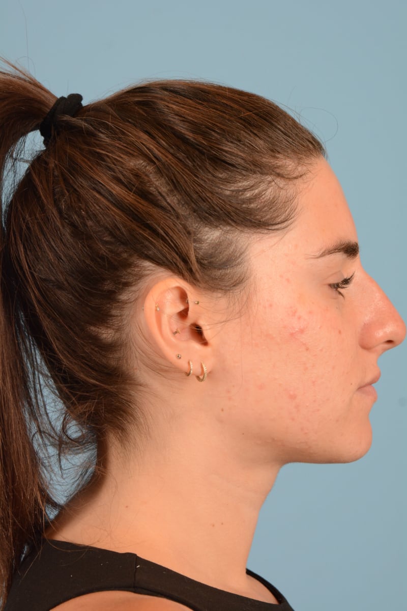 Sebacia (Acne Treatment) Before & After Image