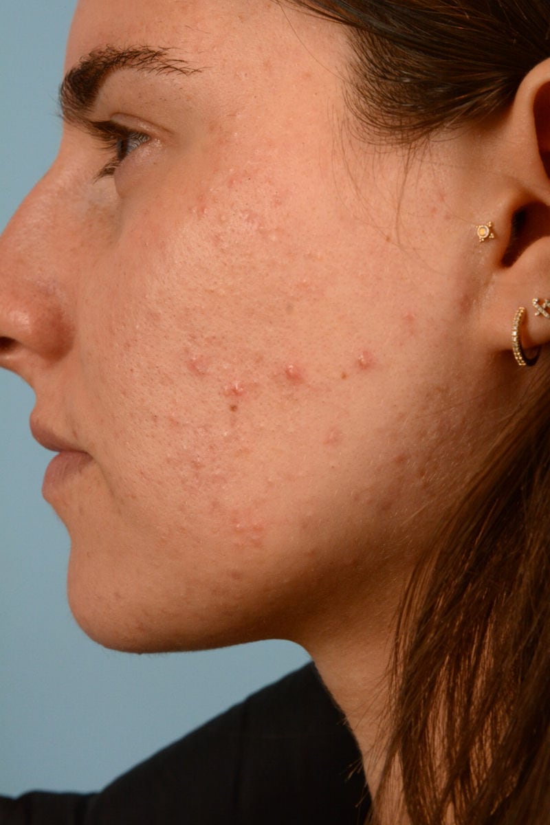 Sebacia (Acne Treatment) Before & After Image