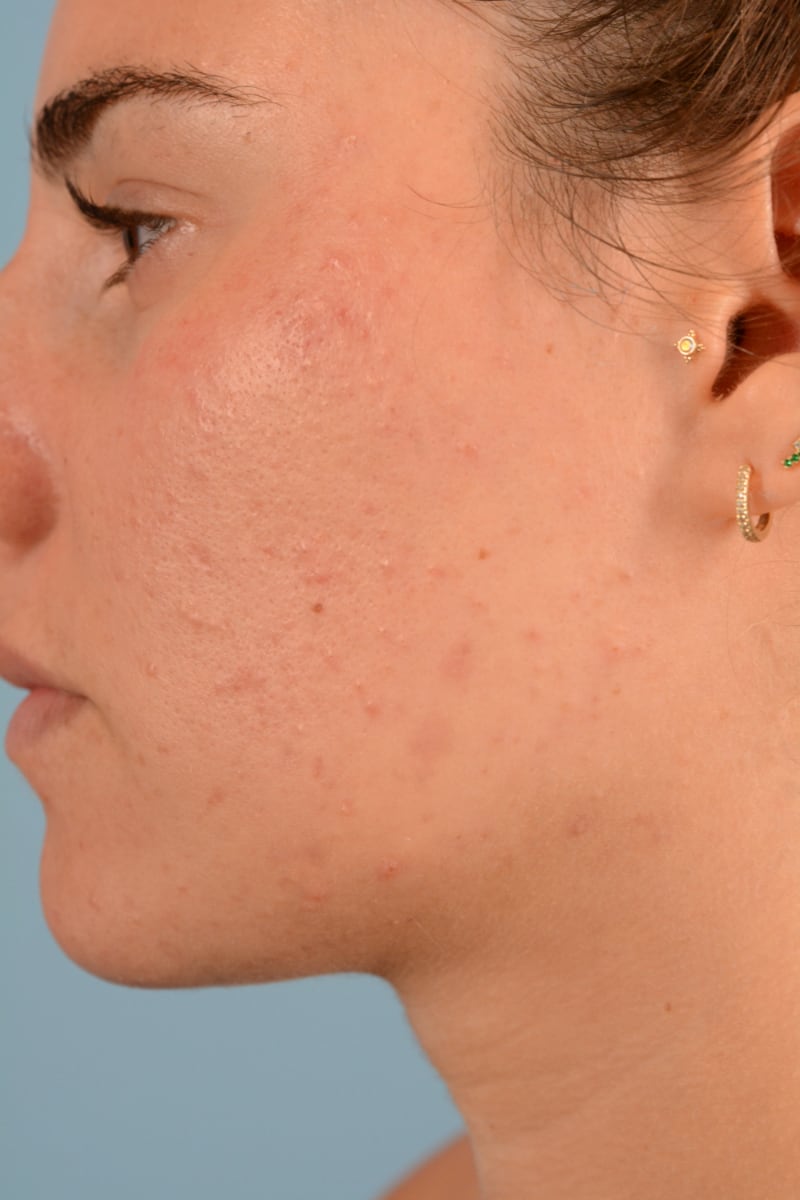 Sebacia (Acne Treatment) Before & After Image