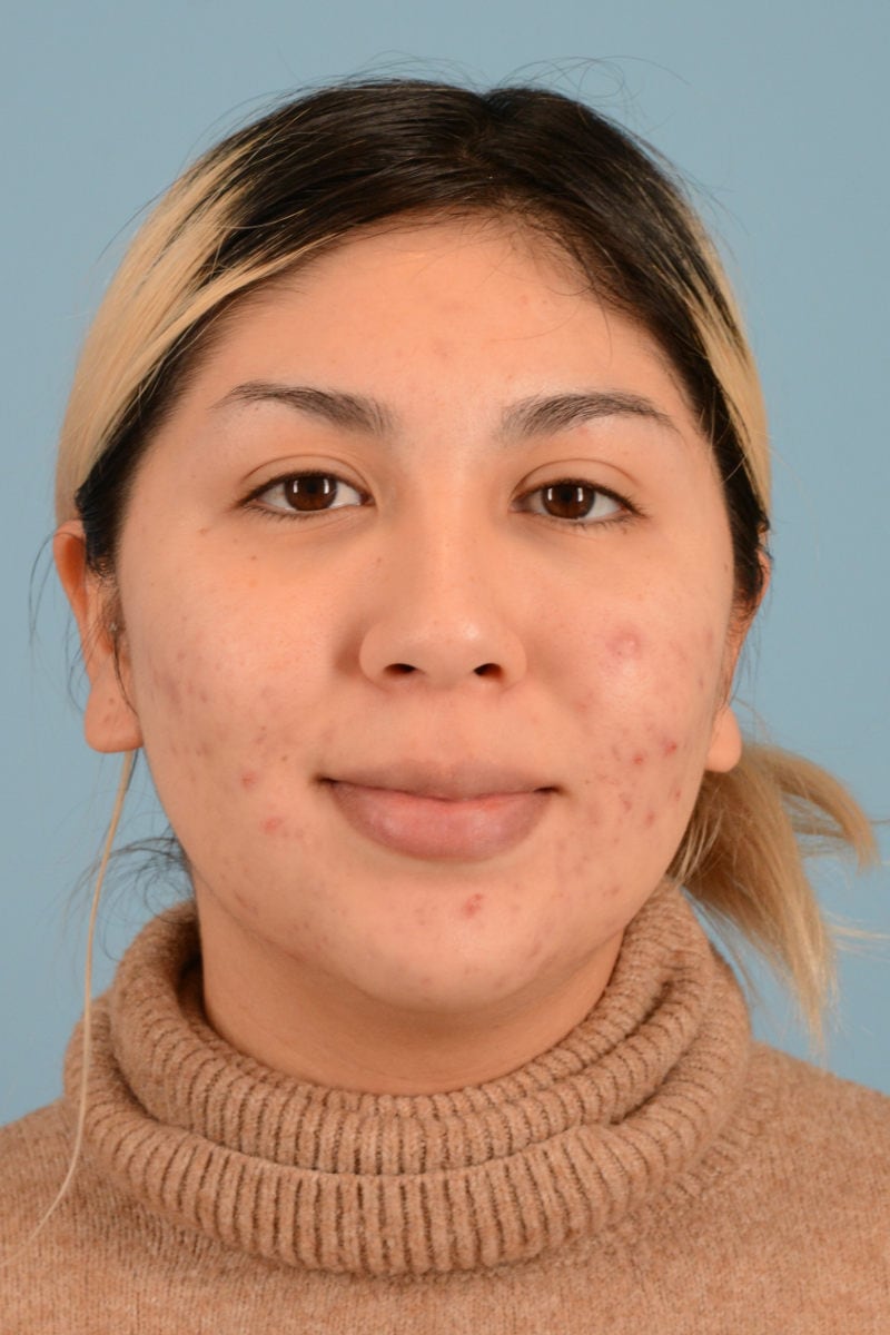 Sebacia (Acne Treatment) Before & After Image