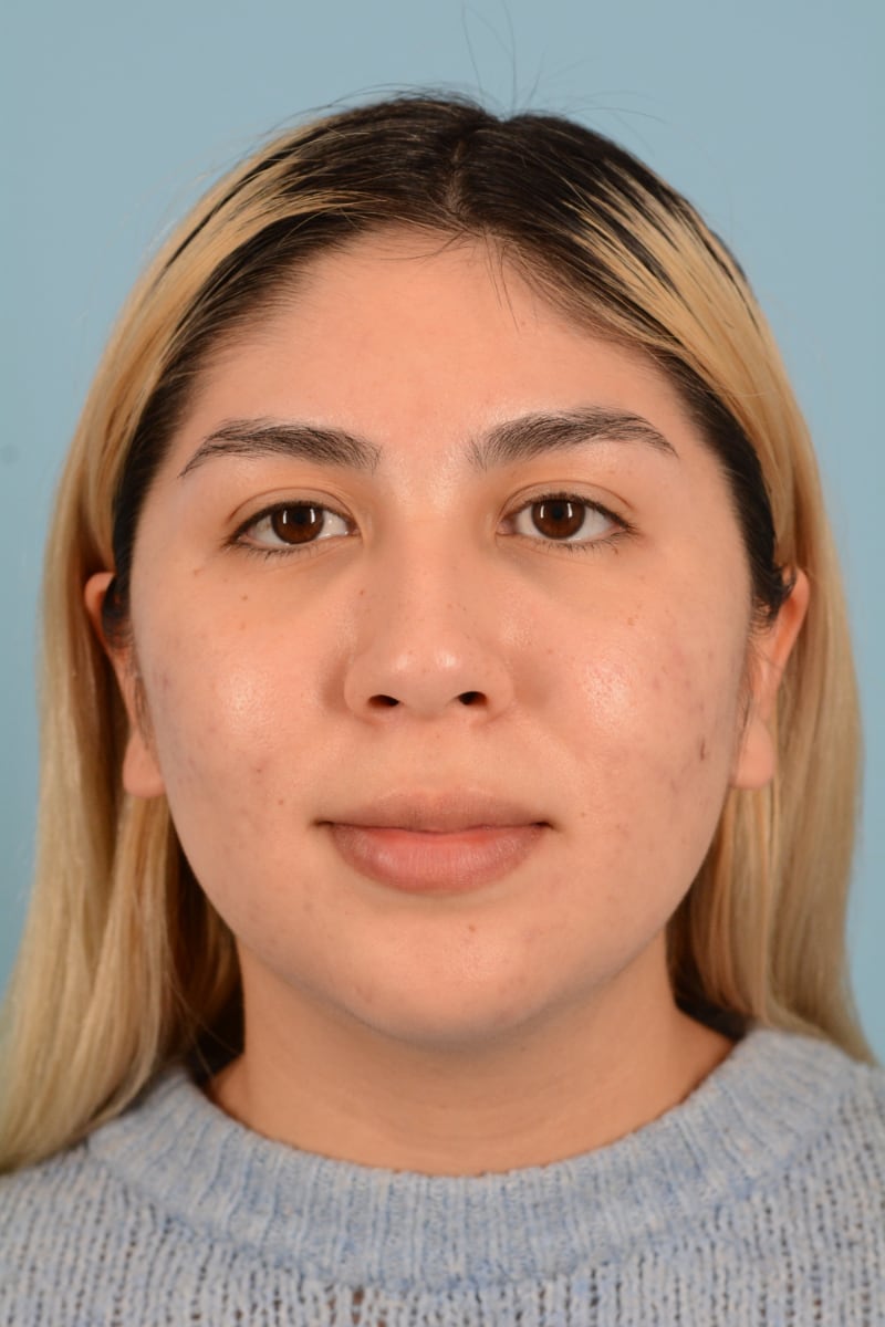 Sebacia (Acne Treatment) Before & After Image