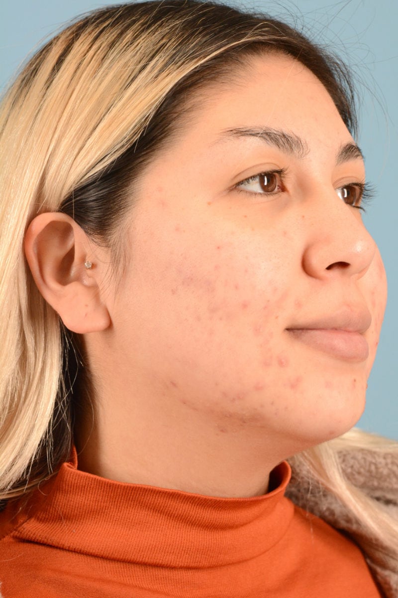Sebacia (Acne Treatment) Before & After Image