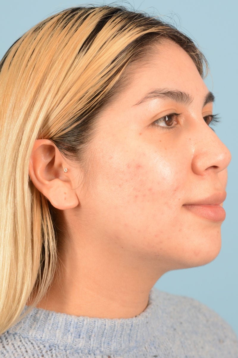 Sebacia (Acne Treatment) Before & After Image