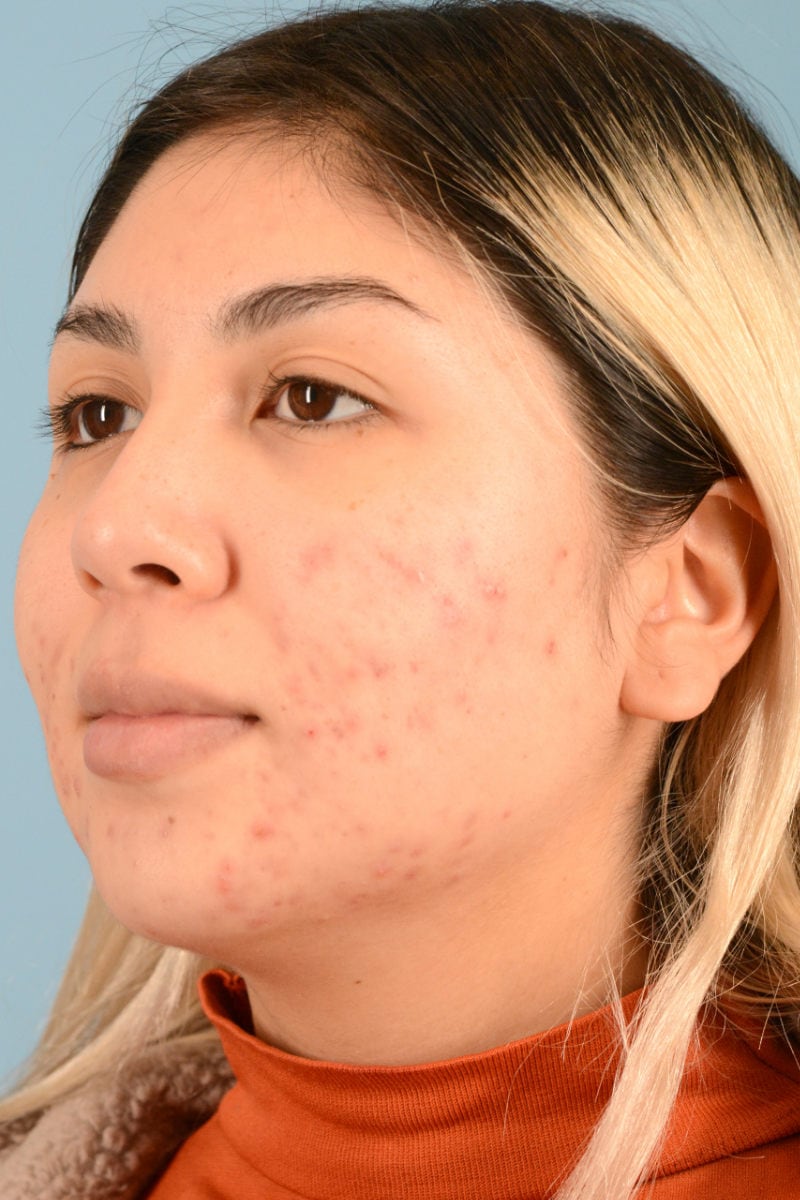 Sebacia (Acne Treatment) Before & After Image