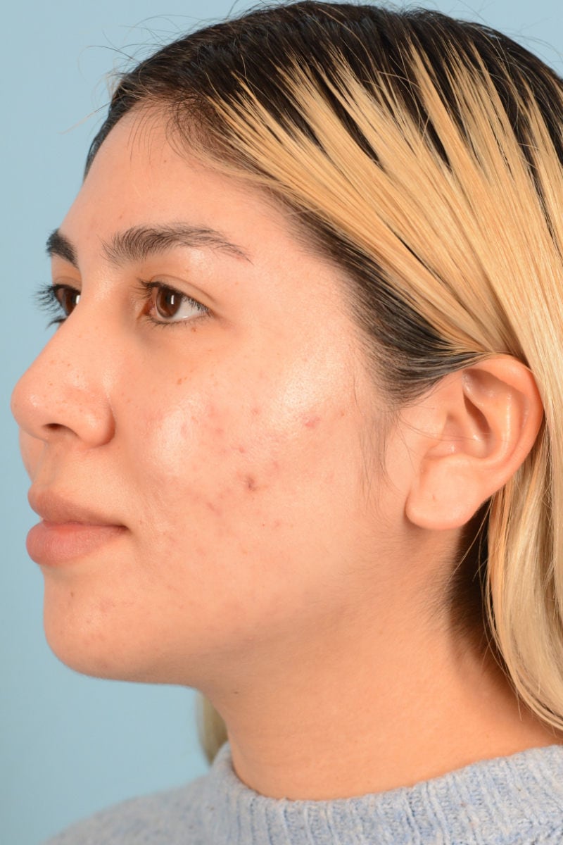Sebacia (Acne Treatment) Before & After Image