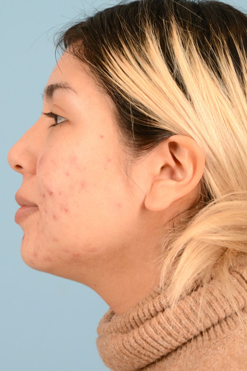 Sebacia (Acne Treatment) Before & After Image