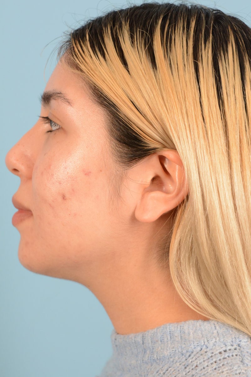 Sebacia (Acne Treatment) Before & After Image