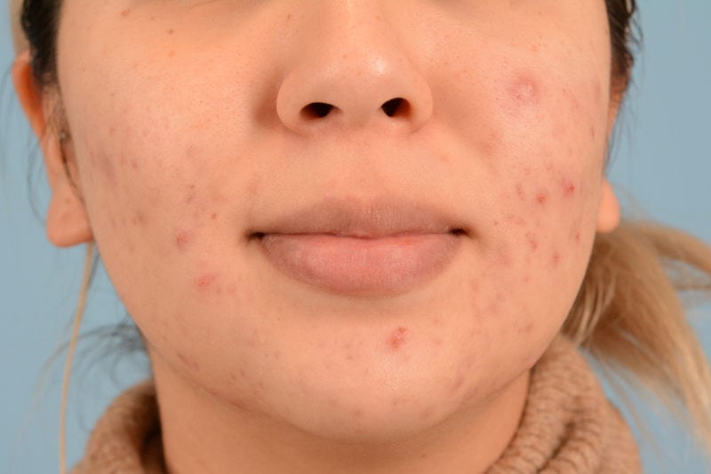 Sebacia (Acne Treatment) Before & After Image