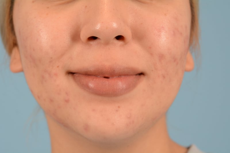 Sebacia (Acne Treatment) Before & After Image