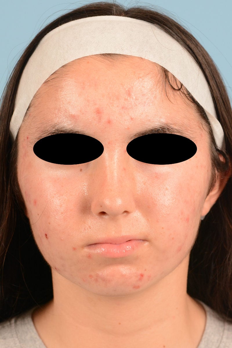 Sebacia (Acne Treatment) Before & After Image