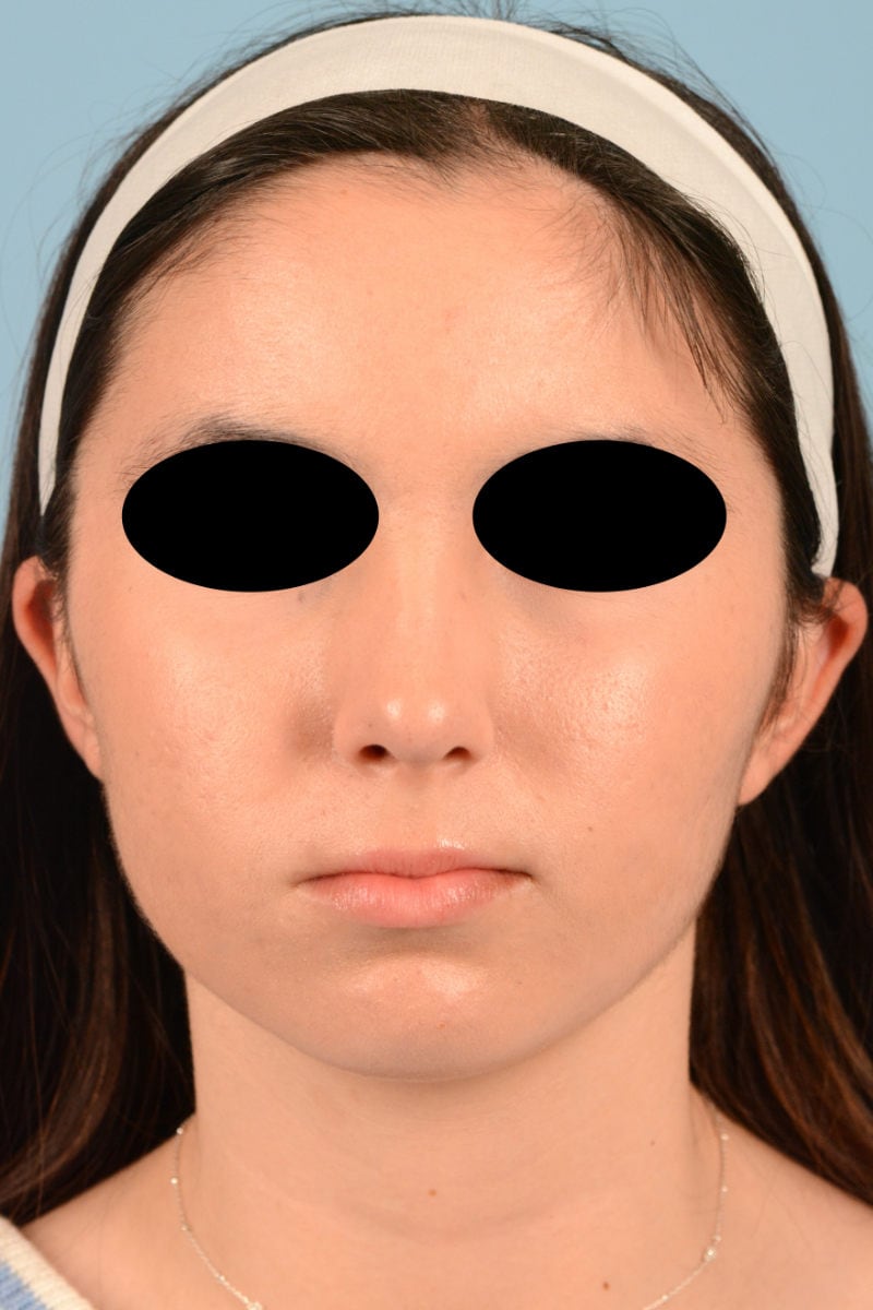 Sebacia (Acne Treatment) Before & After Image