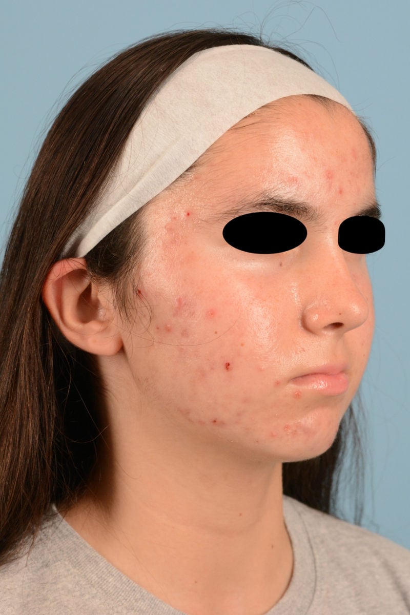 Sebacia (Acne Treatment) Before & After Image