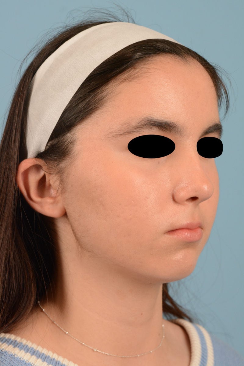 Sebacia (Acne Treatment) Before & After Image