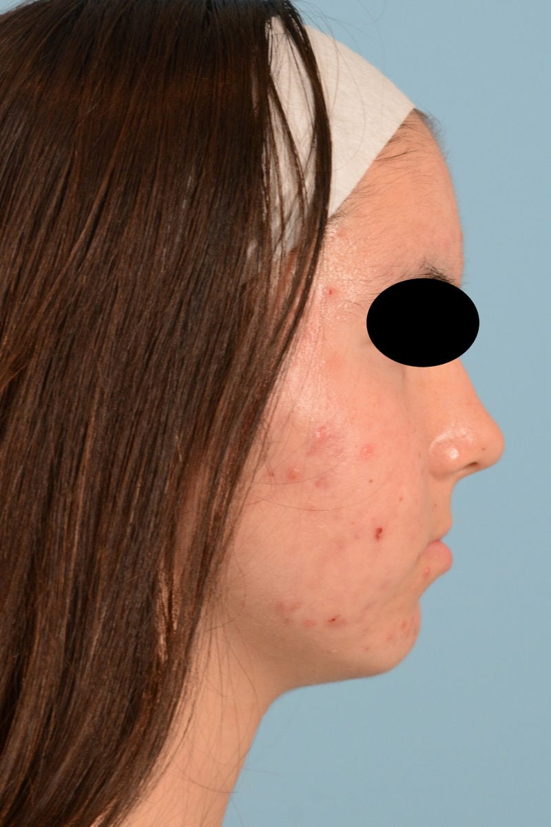 Sebacia (Acne Treatment) Before & After Image