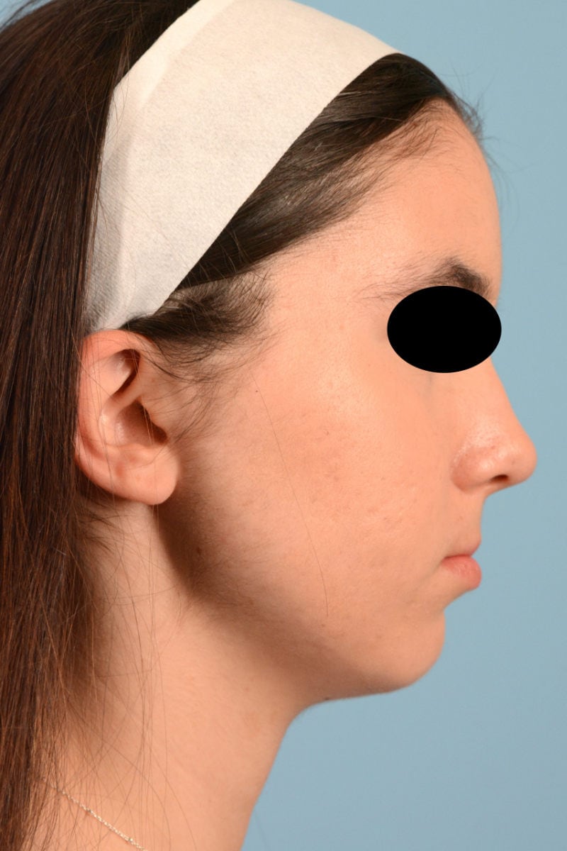 Sebacia (Acne Treatment) Before & After Image