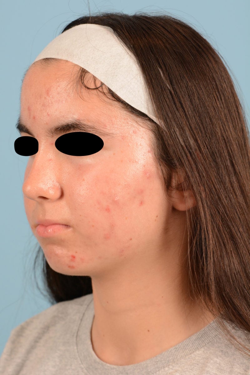 Sebacia (Acne Treatment) Before & After Image