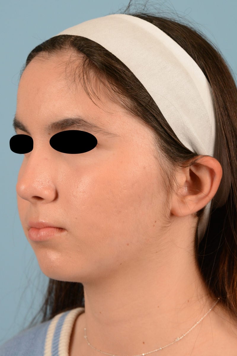 Sebacia (Acne Treatment) Before & After Image