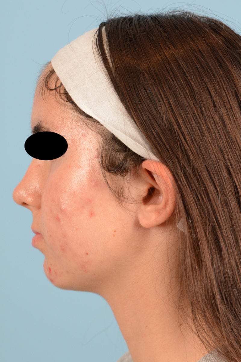 Sebacia (Acne Treatment) Before & After Image