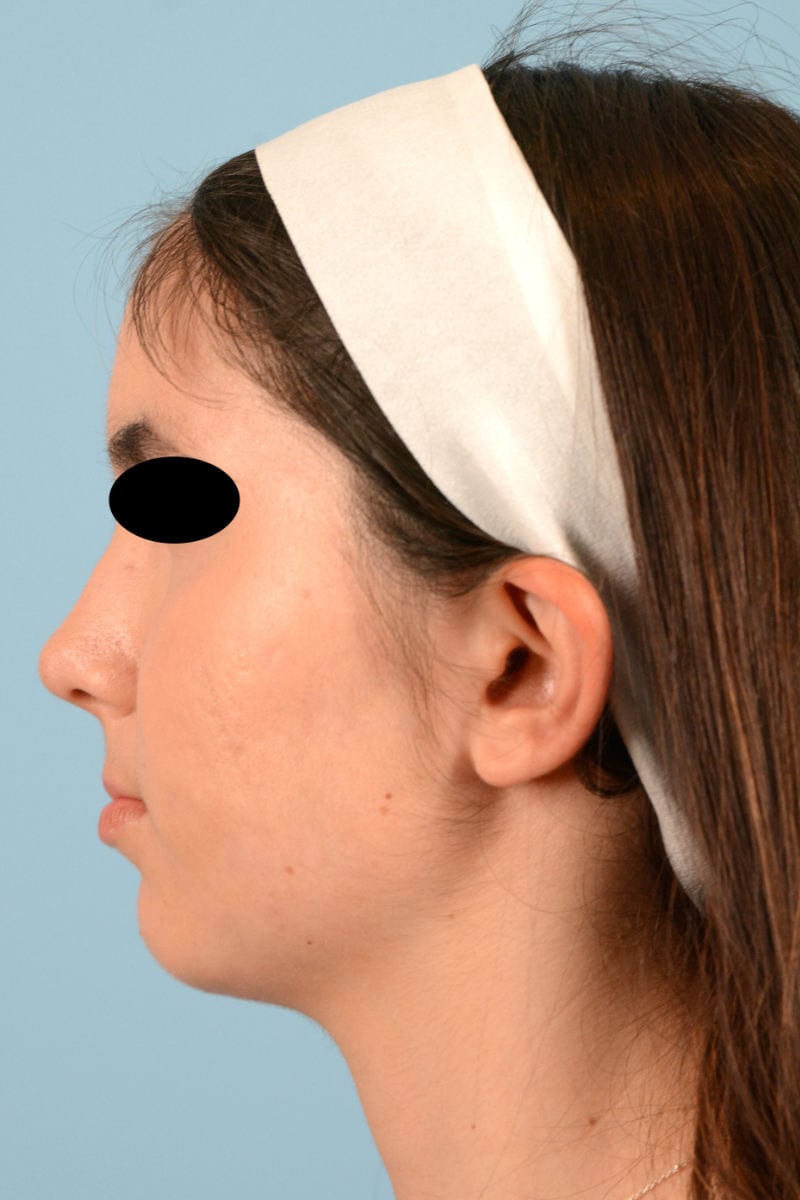 Sebacia (Acne Treatment) Before & After Image