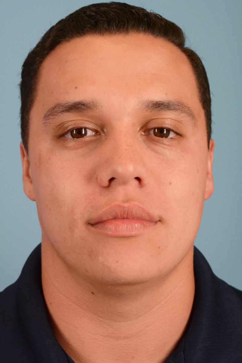 Sebacia (Acne Treatment) Before & After Image