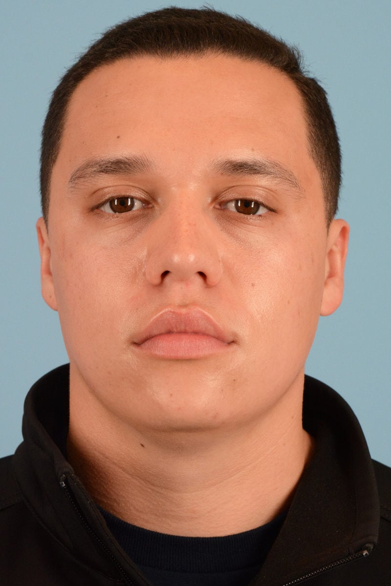 Sebacia (Acne Treatment) Before & After Image