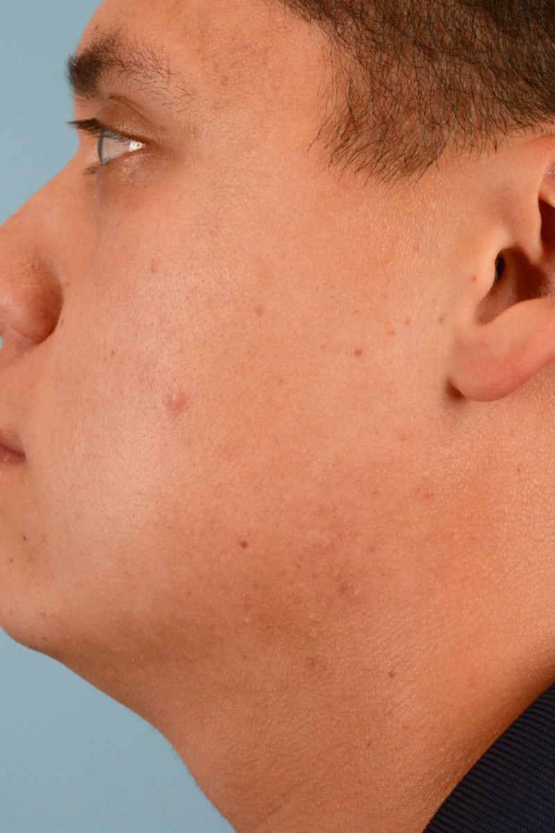 Sebacia (Acne Treatment) Before & After Image