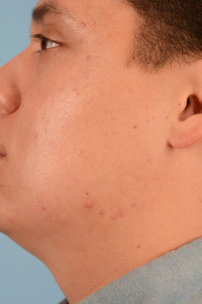 Sebacia (Acne Treatment) Before & After Image