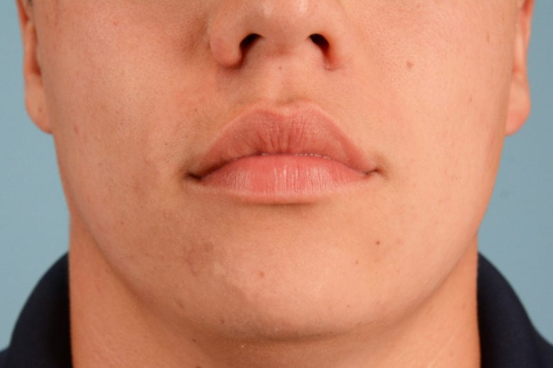 Sebacia (Acne Treatment) Before & After Image