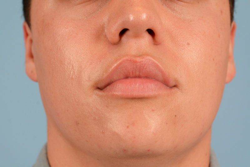 Sebacia (Acne Treatment) Before & After Image